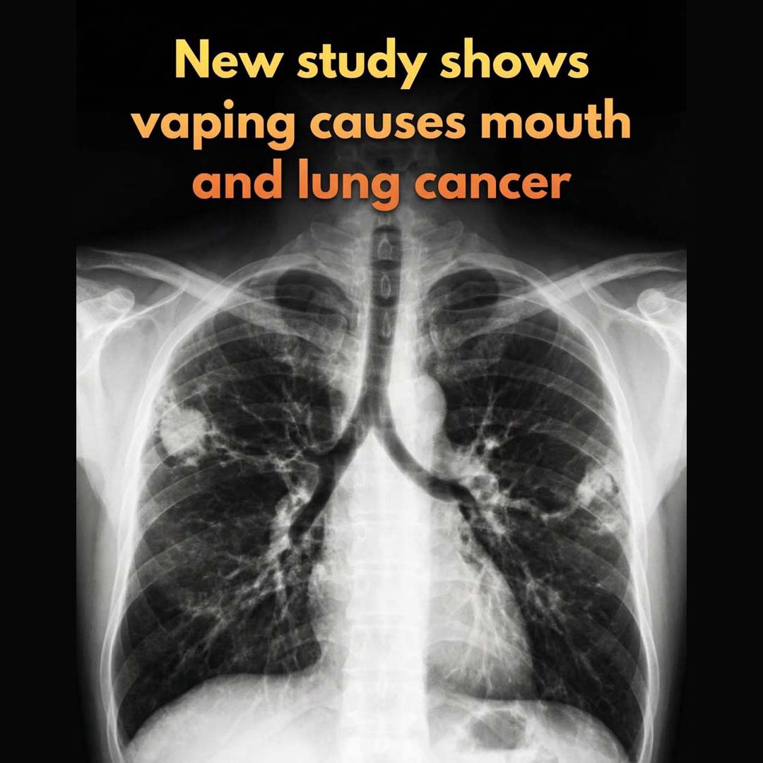 Vaping Likely to Cause Cancer, Major Study Finds