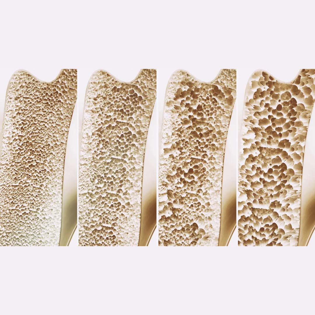Calcium and Vitamin D Supplements DO NOT Prevent Fractures in Older Adults